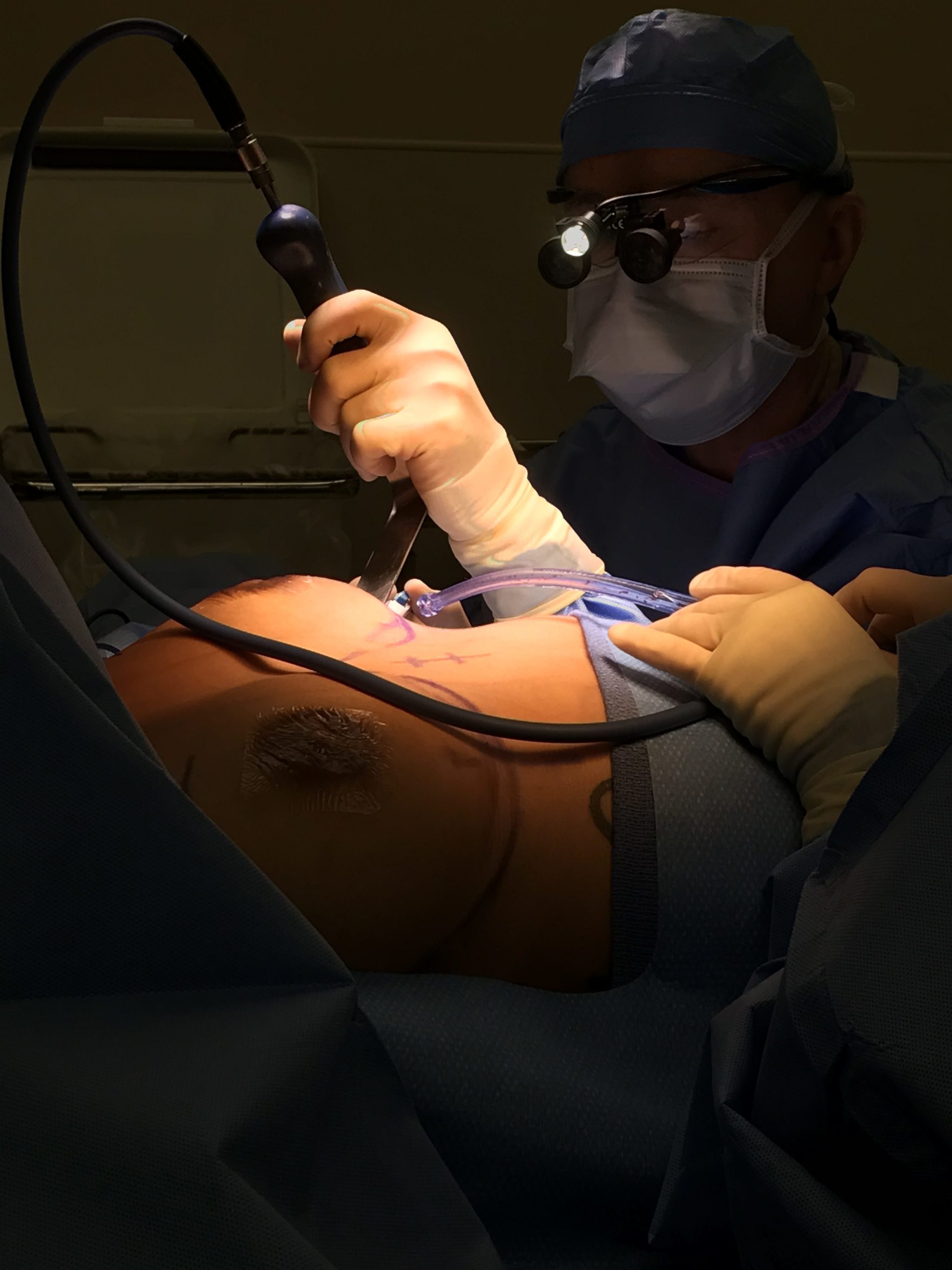 Fort Worth plastic surgeon Dr. Kelly Kunkel performing breast augmentation surgery.