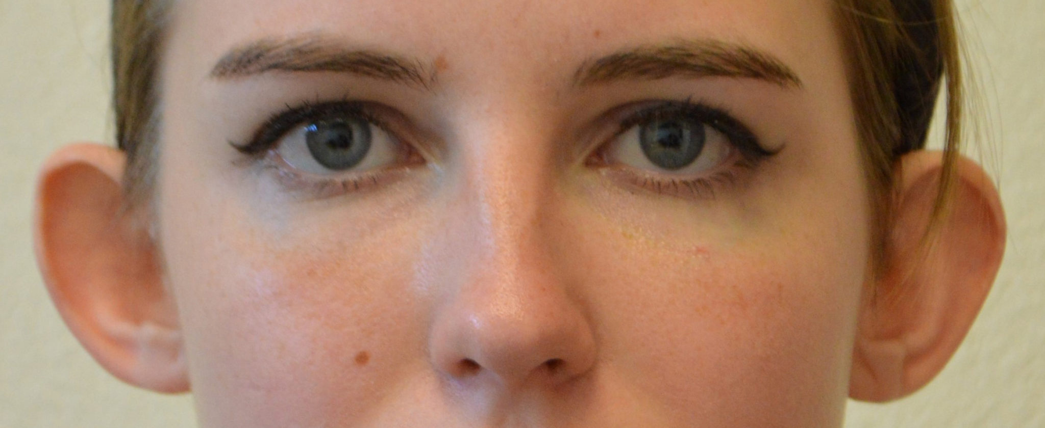 Photo of woman before otoplasty surgery in Fort Worth