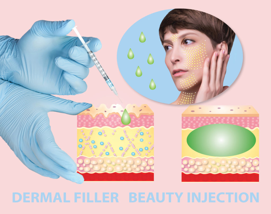 illustration of cross section of human skin being injected with restylane, showing how the filler treats skin