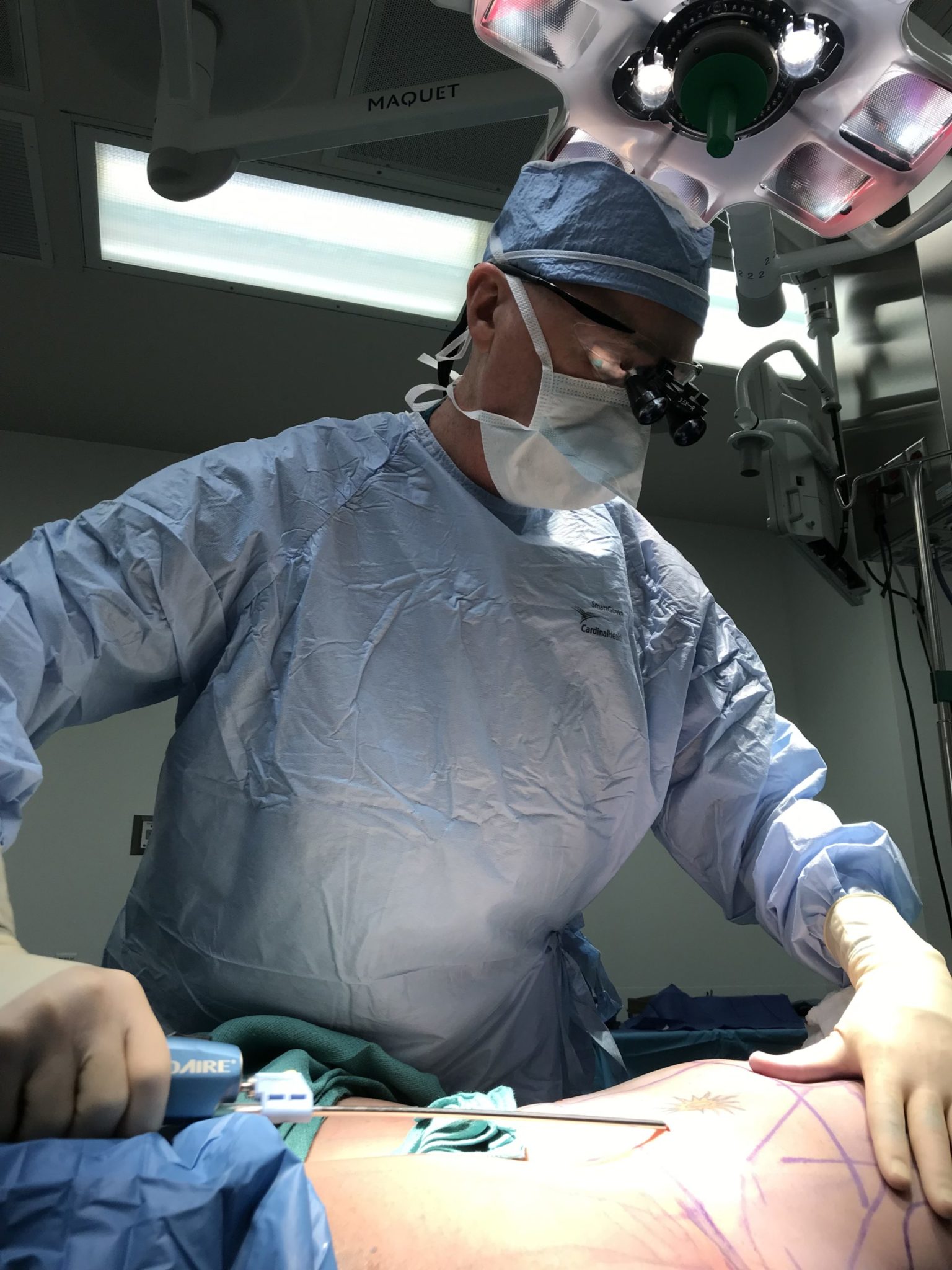 Photograph of Dr. Kunkel performing liposuction in Fort Worth