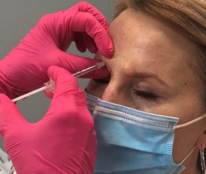 Botox injection in glabellar area