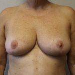 Photo after breast reduction surgery in Fort Worth