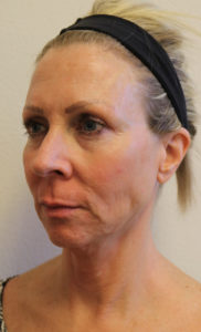 Oblique photo of a woman before a facelift in Fort Worth