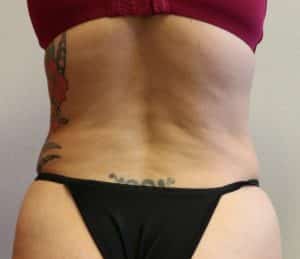 Photo of a back after liposuction in Fort Worth Texas by Dr. Kunkel