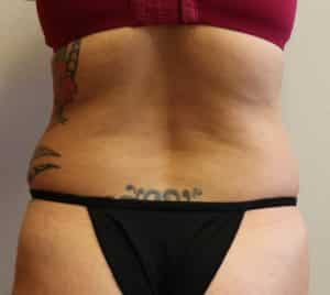 Supplies for Body Contour Surgery: Abdominoplasty, Body Lift