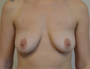Photograph of a woman with glandular ptosis bottom heavy breasts before breast lift in Fort Worth