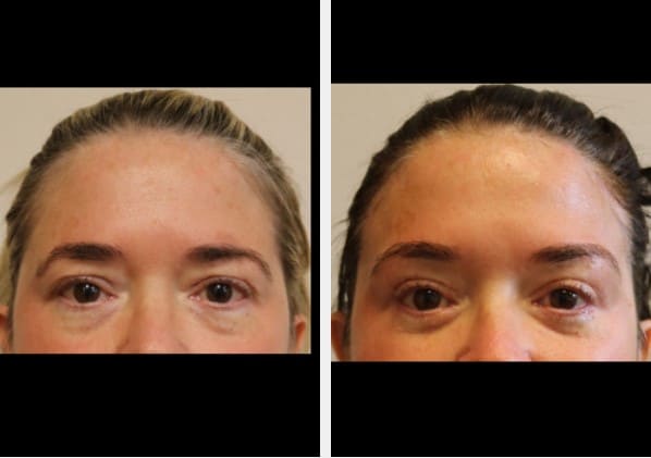Before and after images of woman who underwent Brow Lift surgery.