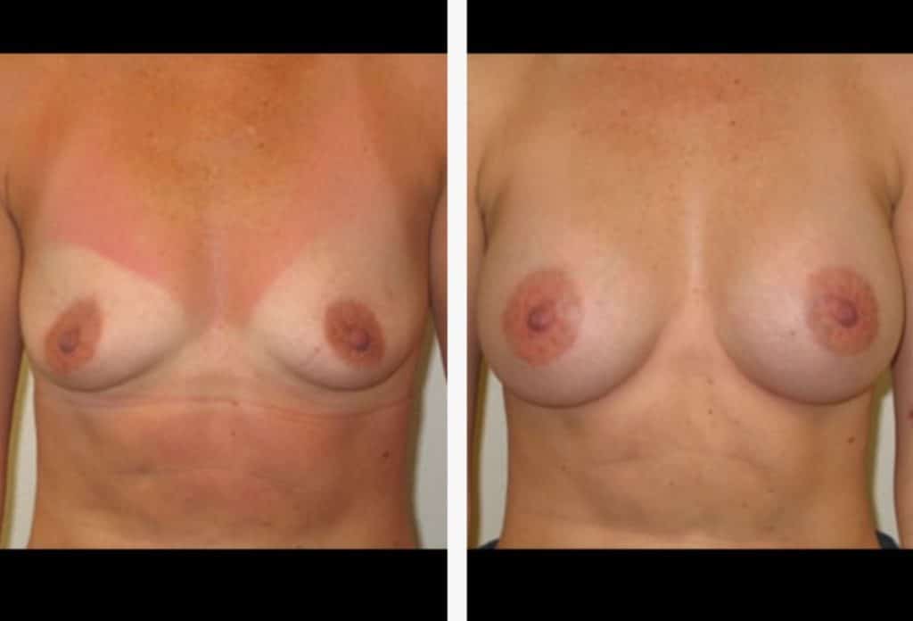 breast augmentation before & after Dr. Kelly Kunkel MD PA