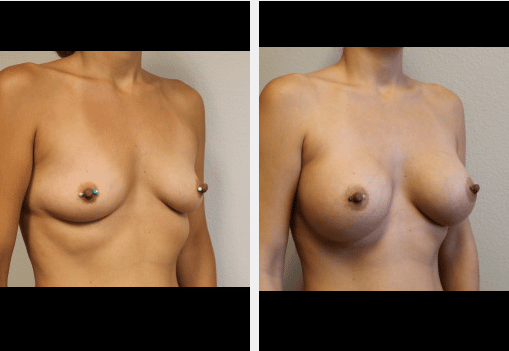 side angle of female patient’s bare chest before and after breast augmentation, breasts larger after procedure