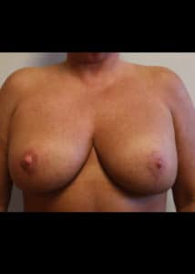 Breast Revision