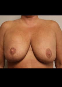 Breast Revision