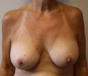 Breast Revision