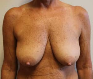 Breast Augmentation with Breast Lift