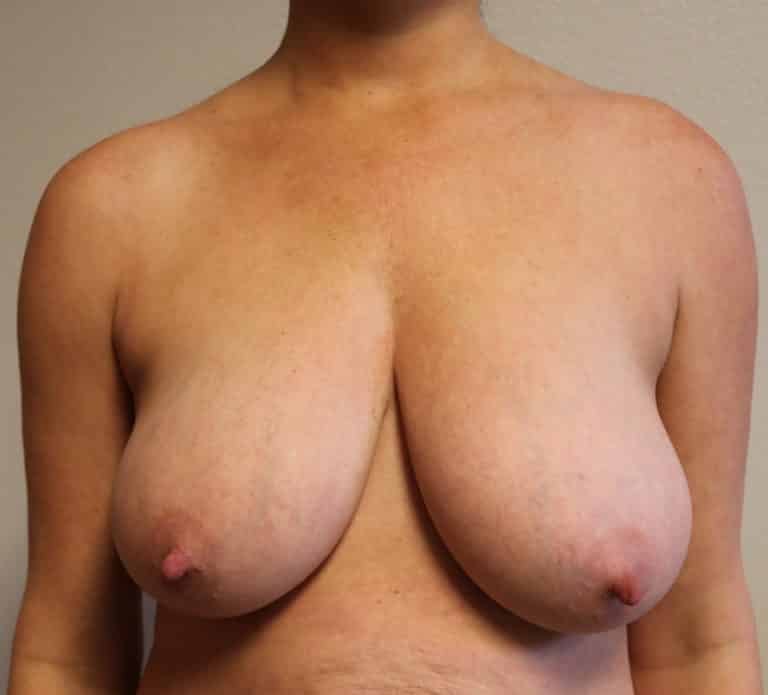 Breast Lift without Augmentation