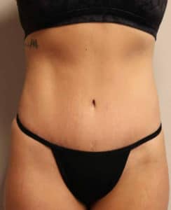 Abdominoplasty