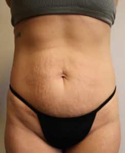 Abdominoplasty