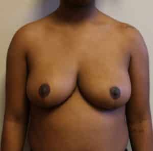 Breast Reduction