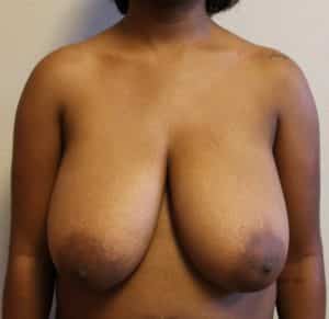 Breast Reduction