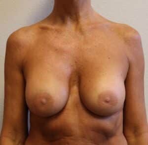 Ruptured Breast Implant