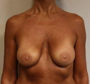 Ruptured Breast Implant