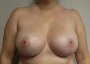 Ruptured Breast Implant