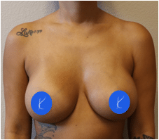 Photograph one year after breast augmentation with saline implants by Fort Worth plastic surgeon Dr. Kunkel