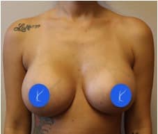 Photograph 3 months after breast augmentation in Fort Worth, Texas by plastic surgeon Dr. Kunkel.
