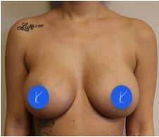 Photograph 6 months after breast augmentation with saline implants by Fort Worth, Texas plastic surgeon Dr. Kunkel.