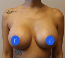 Photograph 6 weeks after breast augmentation by Fort Worth plastic surgeon Dr. Kelly Kunkel.