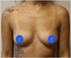 Photograph before breast augmentation with saline breast implants by Fort Worth plastic surgeon Dr. Kunkel.