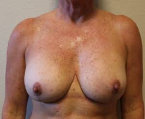 Breast Revision