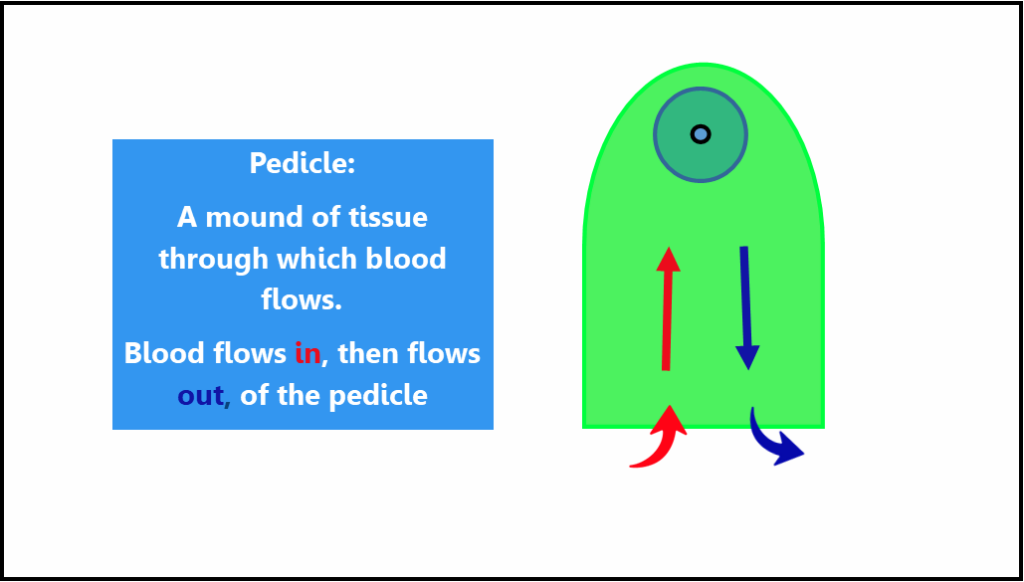 Illustration of a pedicle in breast reduction surgery