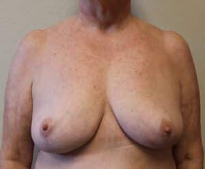 Breast Implant Removal