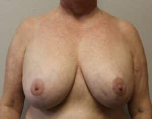 Breast Implant Removal