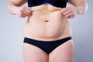 tummy tuck (3)