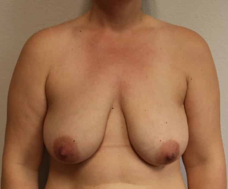 Before Image: Breast Lift without Augmentation - front