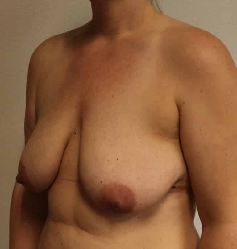 Before Image: Breast Lift without Augmentation - left-front-oblique