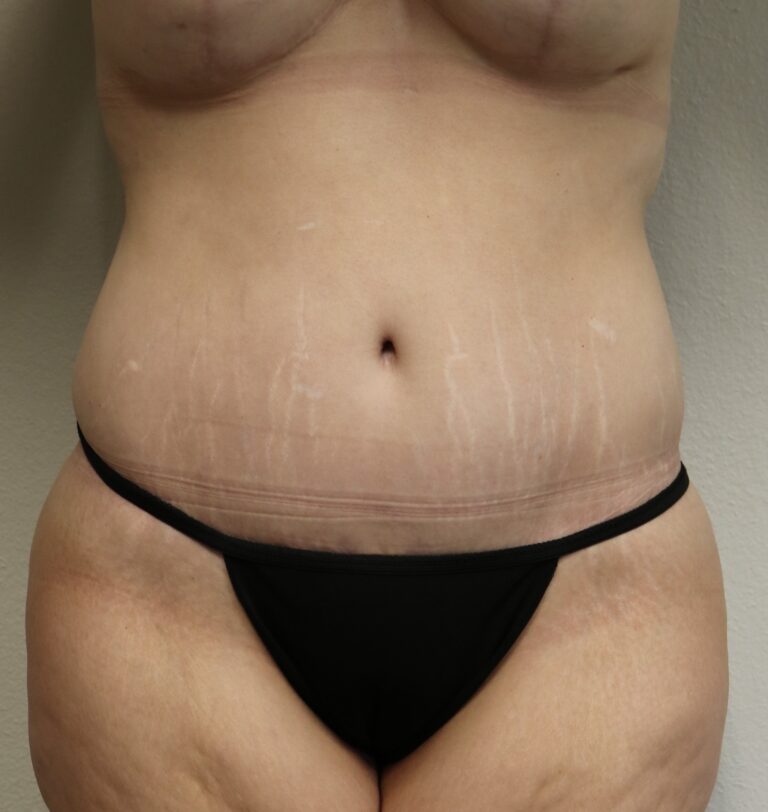 After Image: Tummy Tuck - front