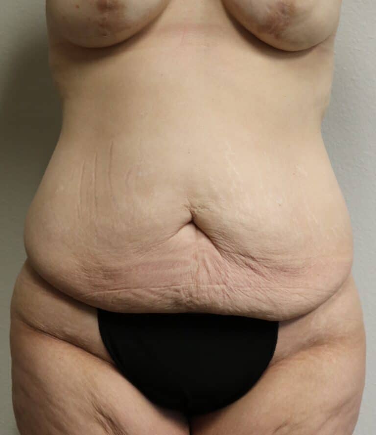 Before Image: Tummy Tuck - front