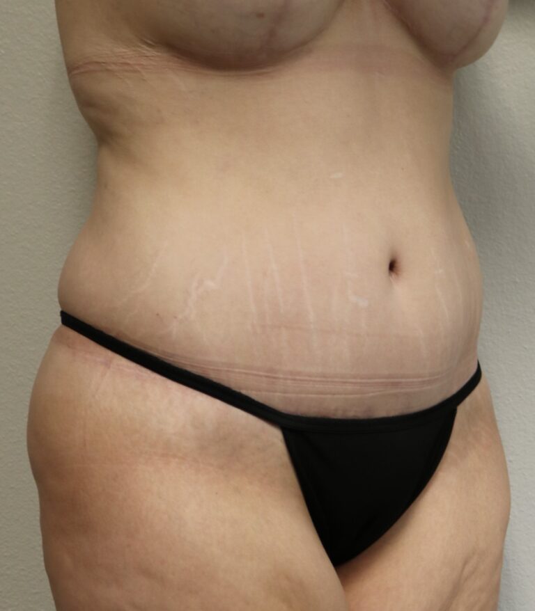 After Image: Tummy Tuck - right-front-oblique