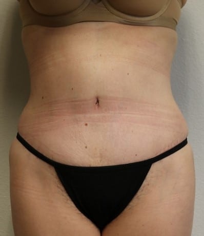 After Image: Tummy Tuck - front