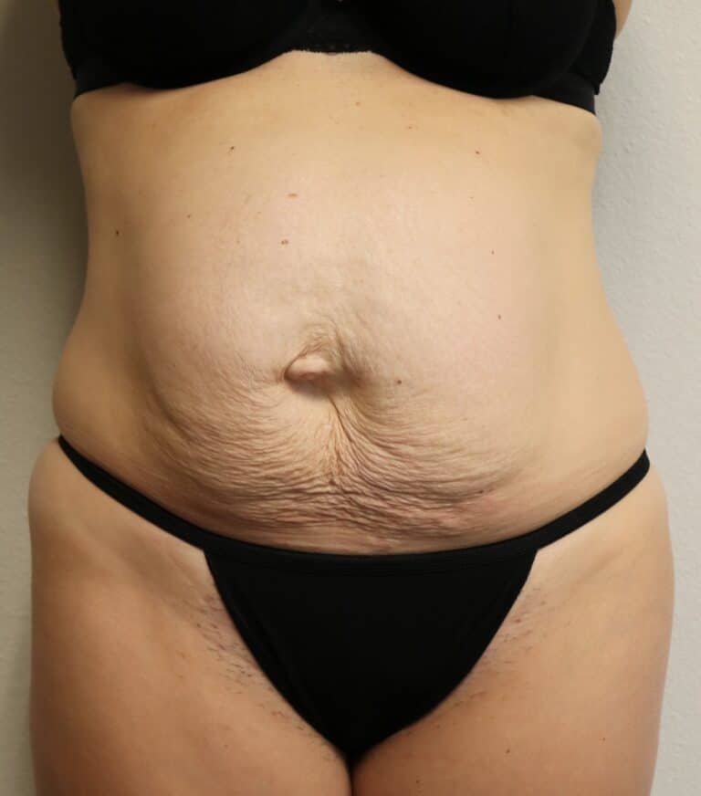 Before Image: Tummy Tuck - front