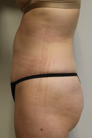 After Image: Tummy Tuck - front