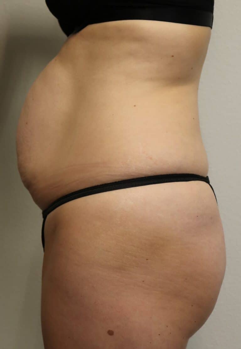 Before Image: Tummy Tuck - front