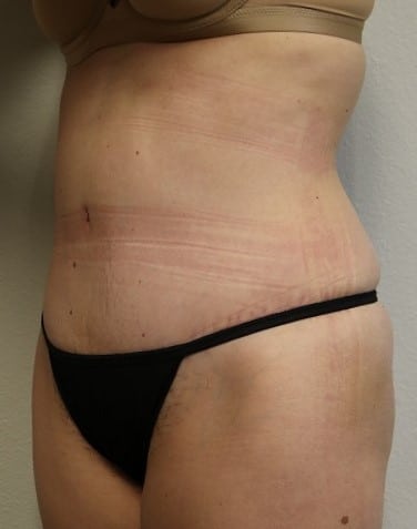 After Image: Tummy Tuck - left-front-oblique