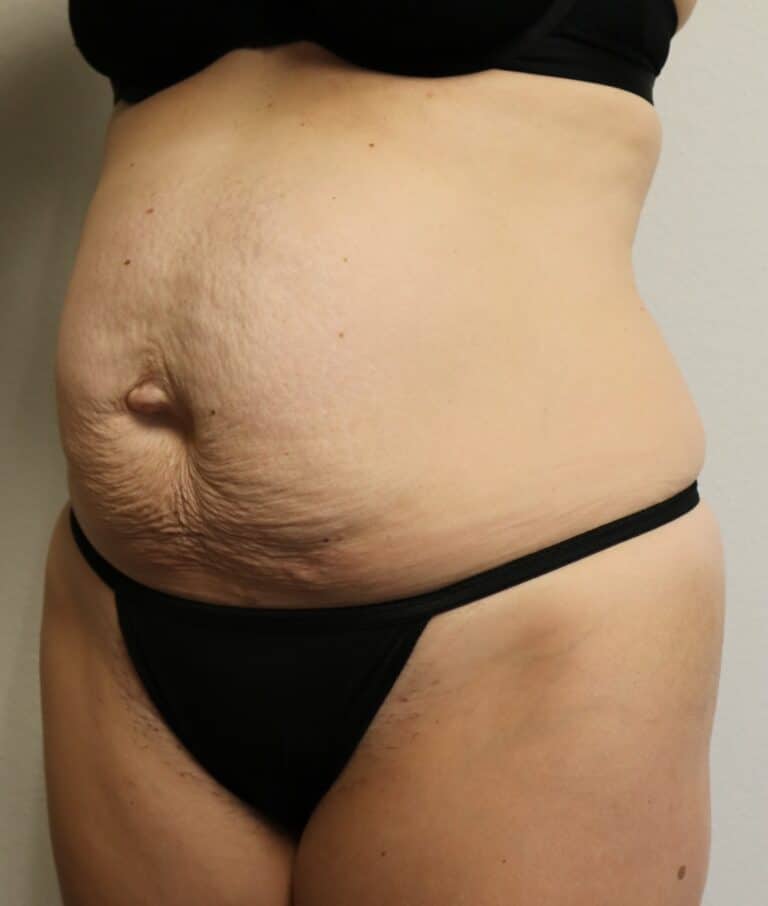 Before Image: Tummy Tuck - left-front-oblique