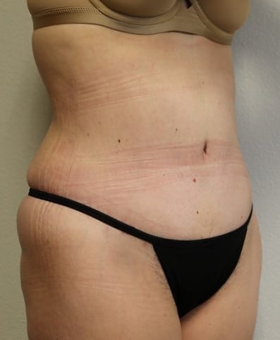 After Image: Tummy Tuck - right-front-oblique