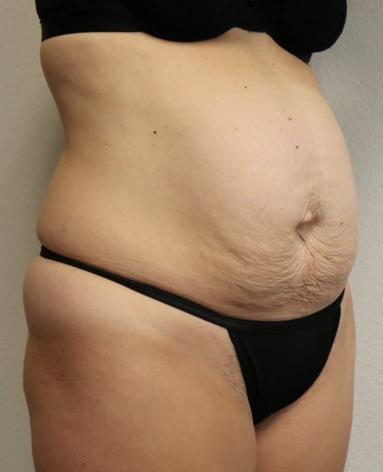 Before Image: Tummy Tuck - right-front-oblique