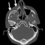 A CT scan showing fractured facial bones