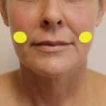 A photo of a woman's cheeks, with the approximate location of the buccal fat pads shown in yellow.